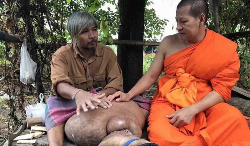泰国男子长出象腿移动患淋巴腺炎的注意了 泰国男子长出象腿是为什么？