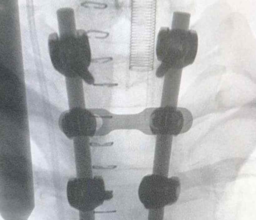 90后男子做俯卧撑致下身瘫痪 做俯卧撑导致瘫痪的原因