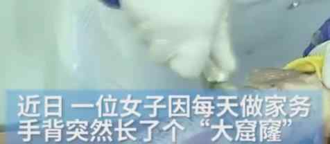 广东深圳一市民手上出现“大窟窿”急忙就诊 医生一看当场惊了