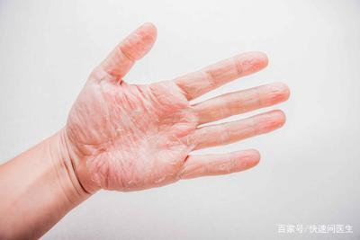 手掌脱皮是什么原因 手脱皮是什么原因导致，4种家常方式，治疗手脱皮