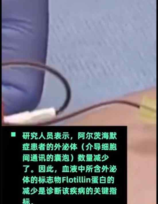 一滴血诊断阿尔茨海默病 如何诊断具体情况