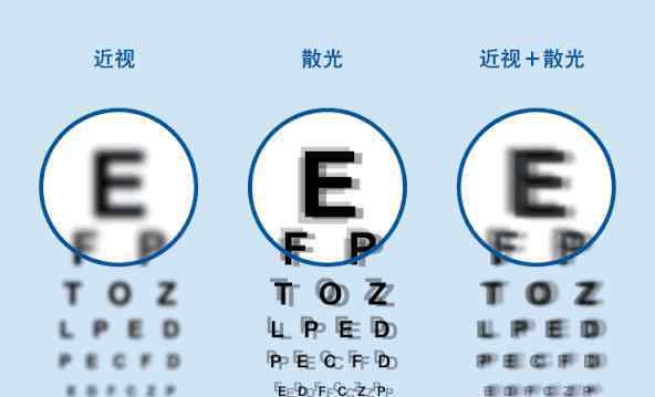 眼睛散光是什么症状 散光到底是什么？你真的以为自己散光吗？