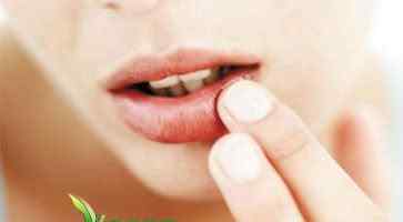 口角炎擦什么药最好 口角炎吃什么药好得快？