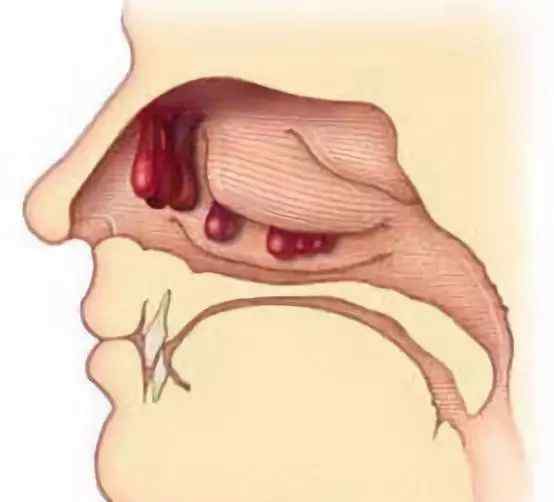 鼻息肉是怎么引起的 鼻息肉的危害那么多，那会癌变吗？该怎么预防呢？