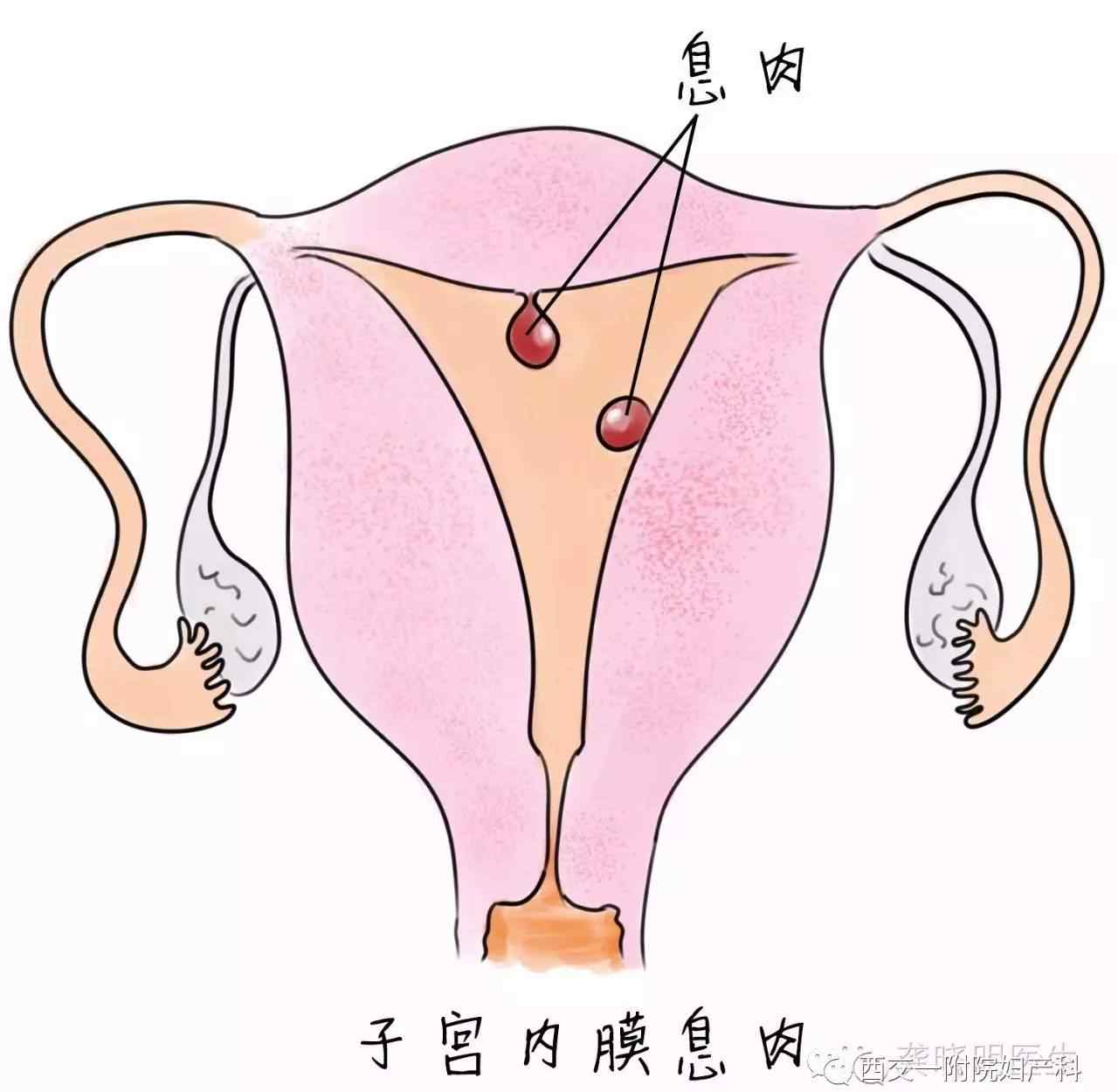 子宫有息肉怎么办 子宫内膜长息肉怎么办？