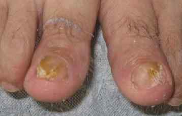 灰指甲能治好么 脚有灰指甲怎么治疗，偏方能治好吗？