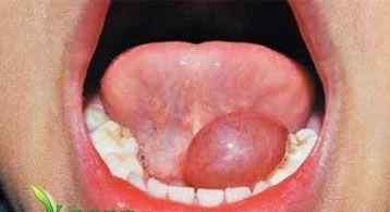 舌下腺囊肿吃什么药 舌下腺囊肿吃什么药好