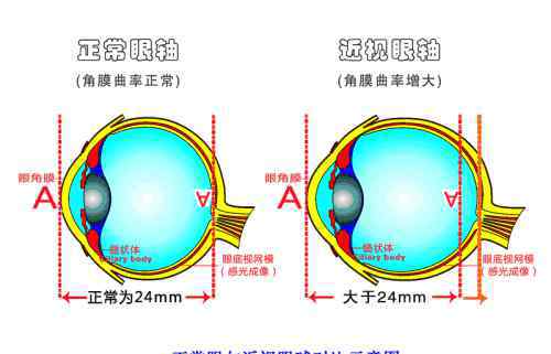 假性近视和真近视有什么不同 假性近视与真性近视有什么区别？学会看视力和度数你就懂了！