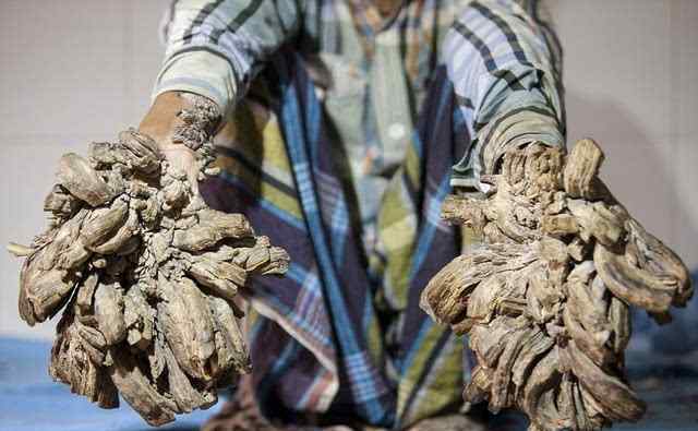 孟加拉“树人”双手长满肉疣如树枝