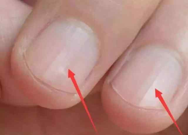 指甲上有凹陷 为什么你的指甲凹陷不平整？可能原因有3个