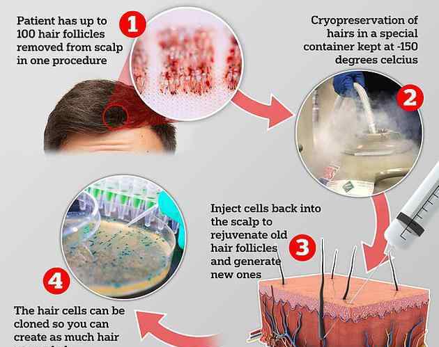 英国推出“克隆”毛囊技术 复制毛囊细胞并对你进行头皮注射
