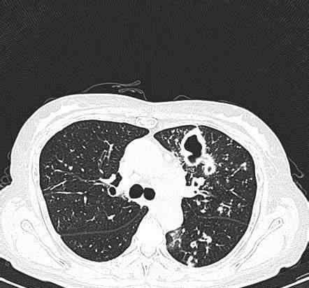 肺结核会复发吗 陈旧性肺结核会复发吗？
