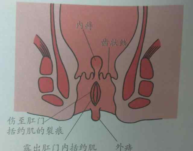 混合痔4期图片 痔疮有3型4期，你是哪一型，哪一期？