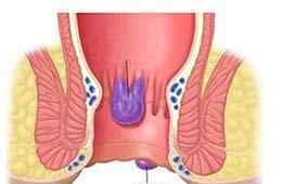 混合痔4期图片 痔疮有3型4期，你是哪一型，哪一期？