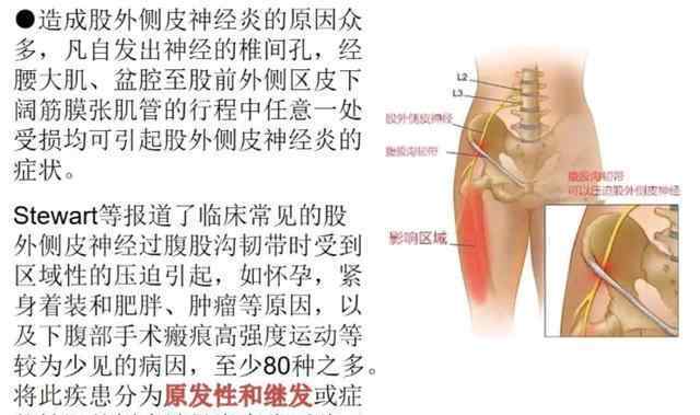 股外侧皮神经炎 股外侧皮神经炎概述