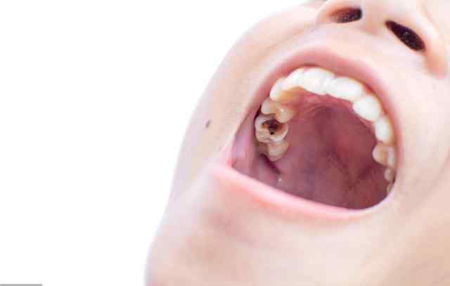 牙齿残根20几年了没拔 牙齿残根别乱拔，留着能有大作用，听听牙科医生的真心建议