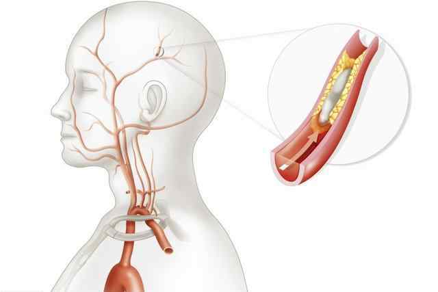 脑血管梗塞 脑血管堵塞前，身体会发出4个“求救”信号，学会2招远离脑梗
