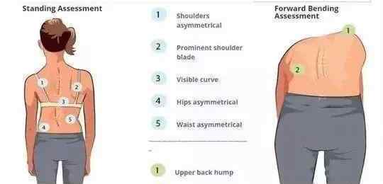 脊柱侧弯自我检测图 孩子坐不端正、头歪、驼背？小心脊柱侧弯，医生教你自我检查