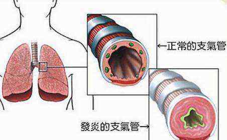 支气管发炎什么症状 什么是气管炎？气管炎的症状是什么？