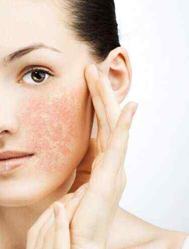 春天皮肤瘙痒怎么办 春天皮肤过敏怎么办 这些原因会导致皮肤过敏