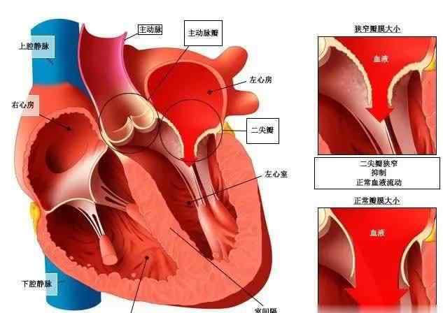 心脏增大能恢复正常吗 心脏瓣膜和心脏功能都正常，但是心房增大了，这意味着什么？
