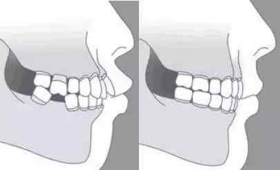 牙齿正常咬合 牙齿咬合正常的状态是什么样呢？