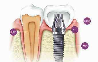 种植牙和真牙 种植牙和真牙一样坚固耐用吗？让这些数据告诉你！
