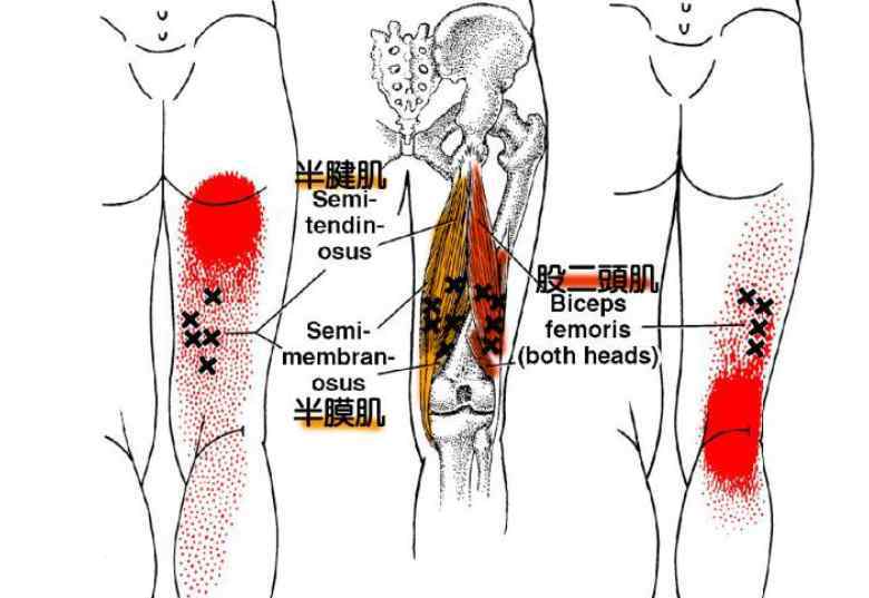 屁股连着大腿后侧筋痛 久坐后出现屁股酸痛，可能是大腿后侧“腘绳肌”惹祸