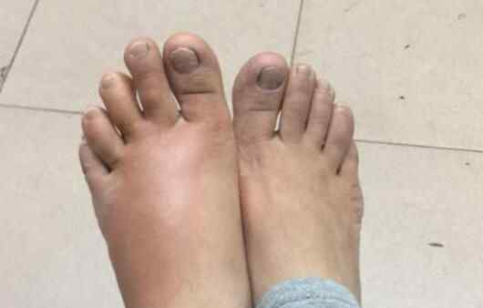 广州女子穿袜子时左脚被咬肿 到底是怎么回事？