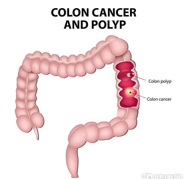 肠癌的早期症状和前兆 肠癌早期，症状很细微：排便有这些情况，留意了