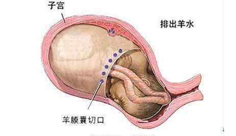 剖腹产恢复不好的特征 剖腹产后子宫恢复不好有哪些症状，这些症状你有吗？