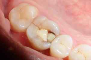 大牙会换牙吗 儿童大牙会换牙吗？乳牙大牙蛀牙要补吗？