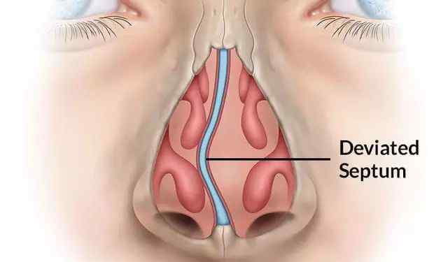 鼻中隔偏曲手术 “鼻中隔偏曲”就要手术？医生：得先了解这些问题