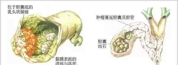 胆结石的偏方 不屑的胆结石：区区偏方就想消灭我，休想！