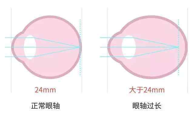 600度的近视 600度以上的高度近视，比起普通近视，要多注意这些！