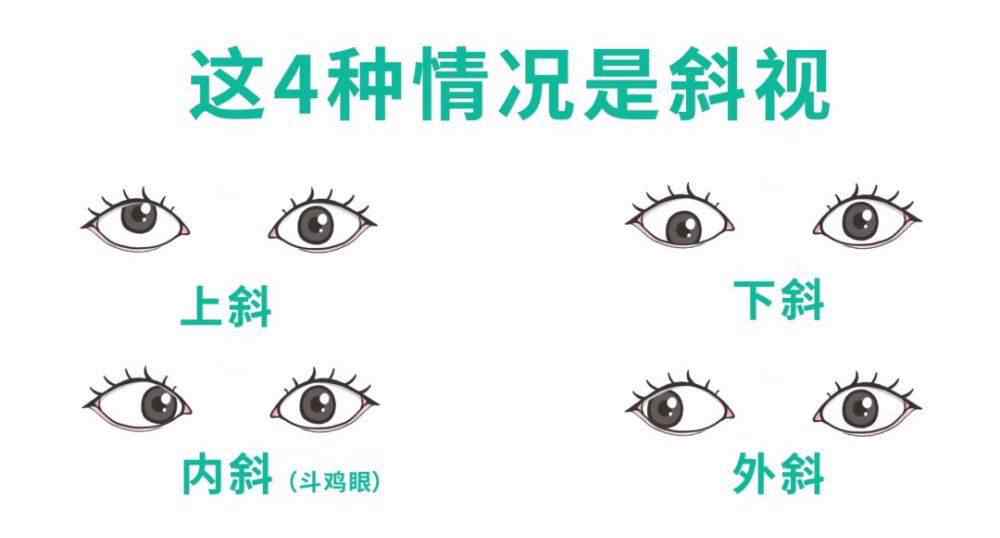 眼睛斜视如何治疗 斜视怎么办？眼睛斜视一定要做手术吗？科普一分钟