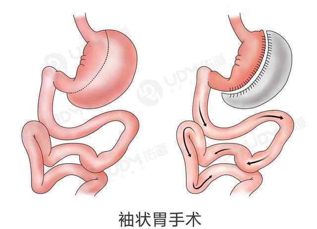 缩胃术减肥法 减肥有新法，缩胃手术你都了解吗？