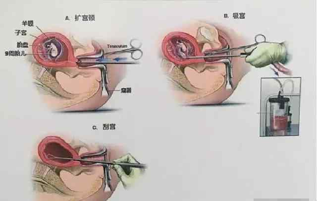 不出血不腹痛会胎停吗 孕妇胎停了，但不肚子痛也不流血是怎么回事？别再无知了