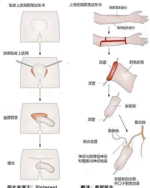 女变男手术过程动画版 医学解密：变性手术过程图示（女变男）