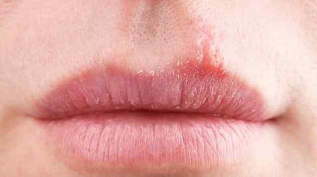 皮肤过敏肿胀怎么办呢 皮肤过敏嘴唇肿怎么治 有哪些处理的办法
