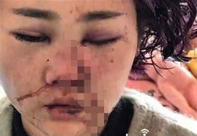 毁容女孩 丽江被打女孩小董毁容图片，揭秘女孩丽江被打原因究竟是什么