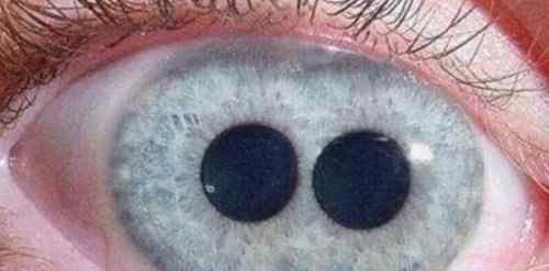 人类5种罕见的瞳孔 人类5种罕见的瞳孔