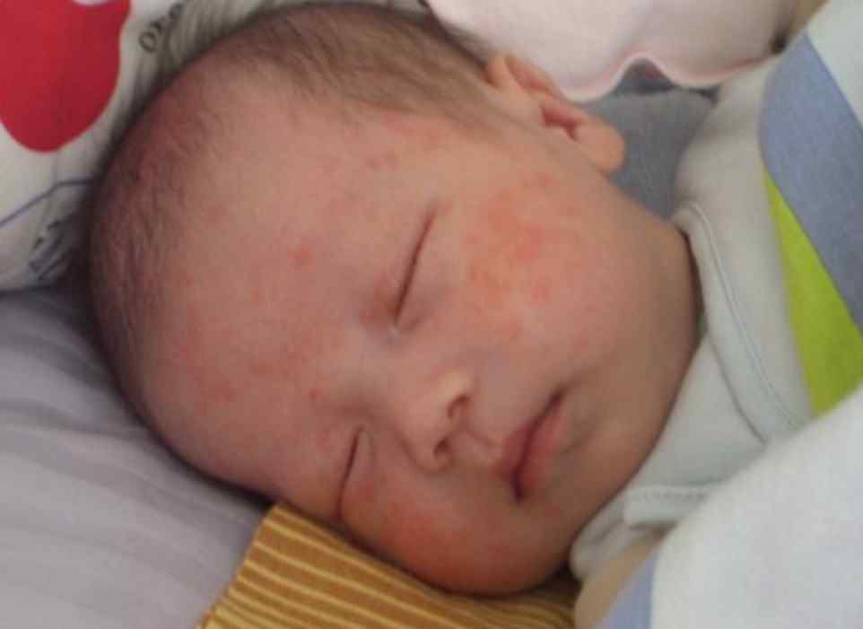 婴儿湿疹的原因 宝宝湿疹的原因总算找到，免疫因素排第4，第1名八成妈妈都想不到
