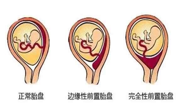 胎盘位置低怎么办 胎盘位置低，怎么办？