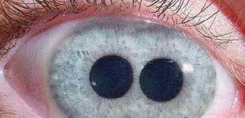 瞳孔异色症 人类5种罕见的瞳孔