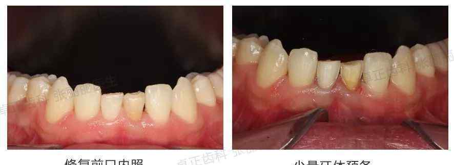 牙齿缺损 牙齿缺损了，可以选择哪些修复方式？