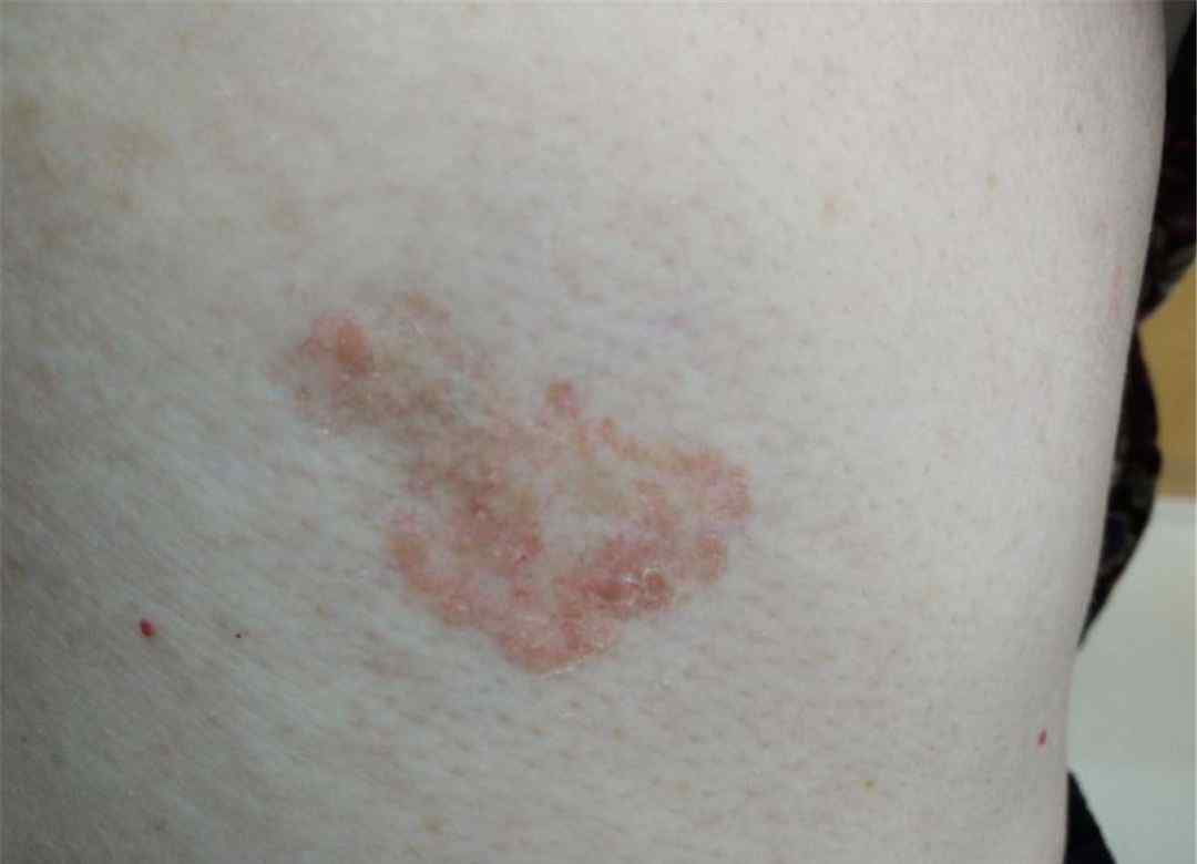 腋下湿疹怎么治 胳肢窝下湿疹变癌症？这些部位的“湿疹”要当心，可能是癌！