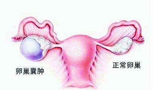 生理性卵巢囊肿 生理性卵巢囊肿会自己消失，怎么判断是生理囊肿？