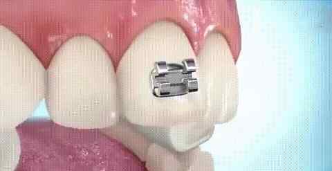 戴牙套 揭秘！牙齿矫正戴牙套的全过程，原来牙套是这样戴上去的！
