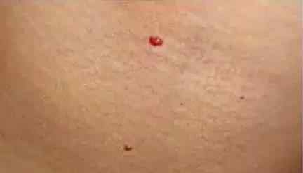 乳房上长红痣图片 身上有这种小红痣，千万别大意，是大病的预警信号！